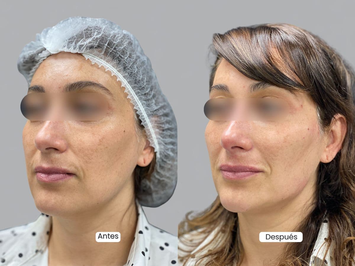 Mesoterapia y Vitaminas