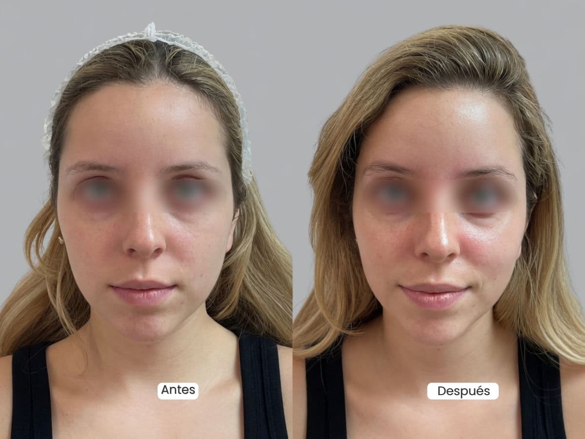 Plasma Rico en Plaquetas (PRP)