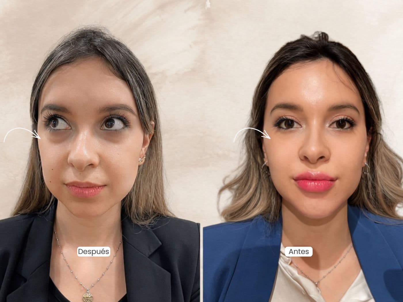 Ácido Hialurónico para Ojeras