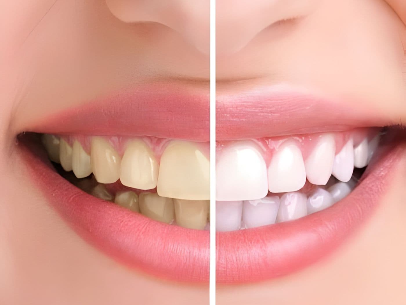 Blanqueamiento Dental