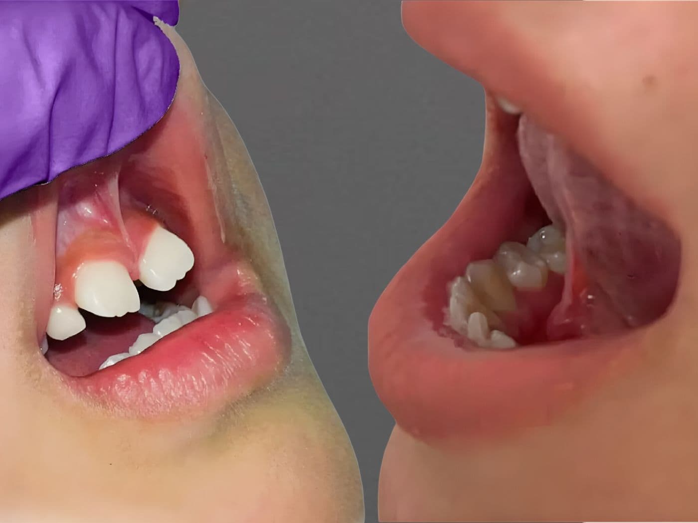 Frenectomía Lingual y Labial