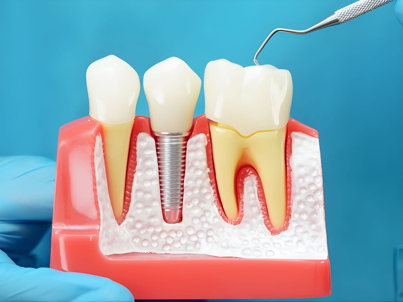 Implantes Dentales